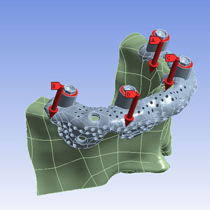 OMX Solutions Osseo-Frame